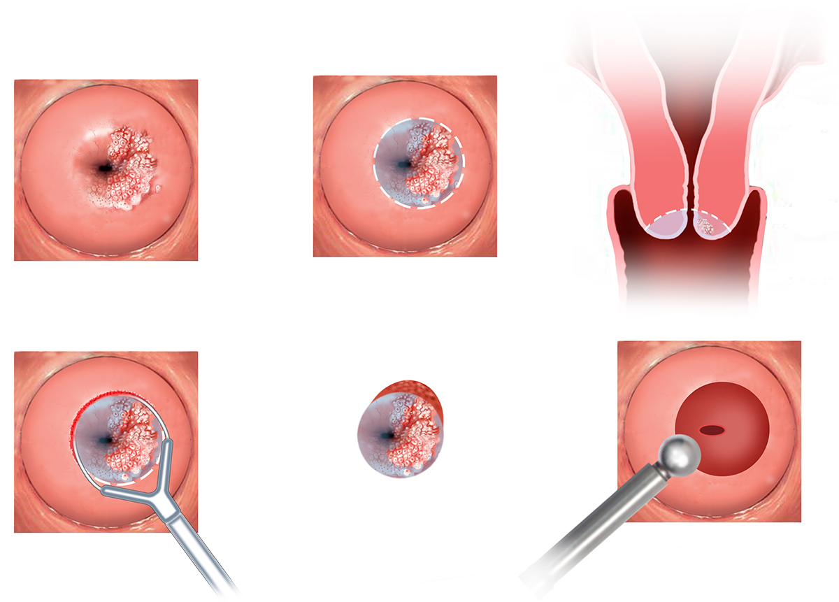 硒与HPV、宫颈癌的关系